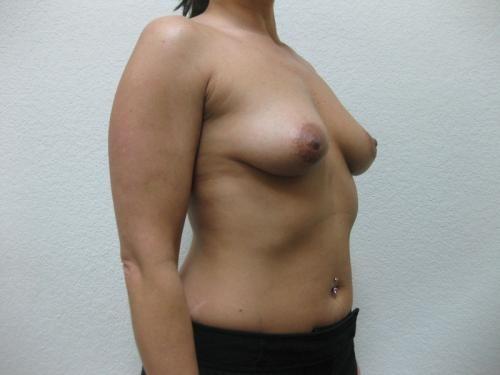 Breast Augmentation - Patient 5 - Before 2
