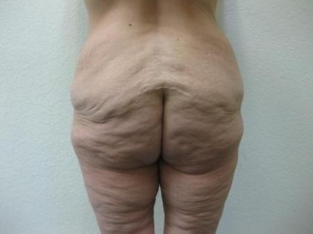 Body Lift - Patient 8 - Before Image 3