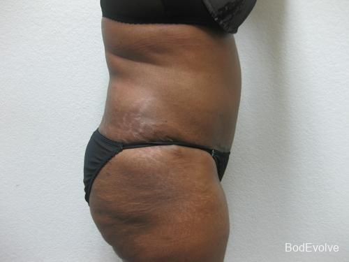 Tummy Tuck - Patient 1 -  After 2