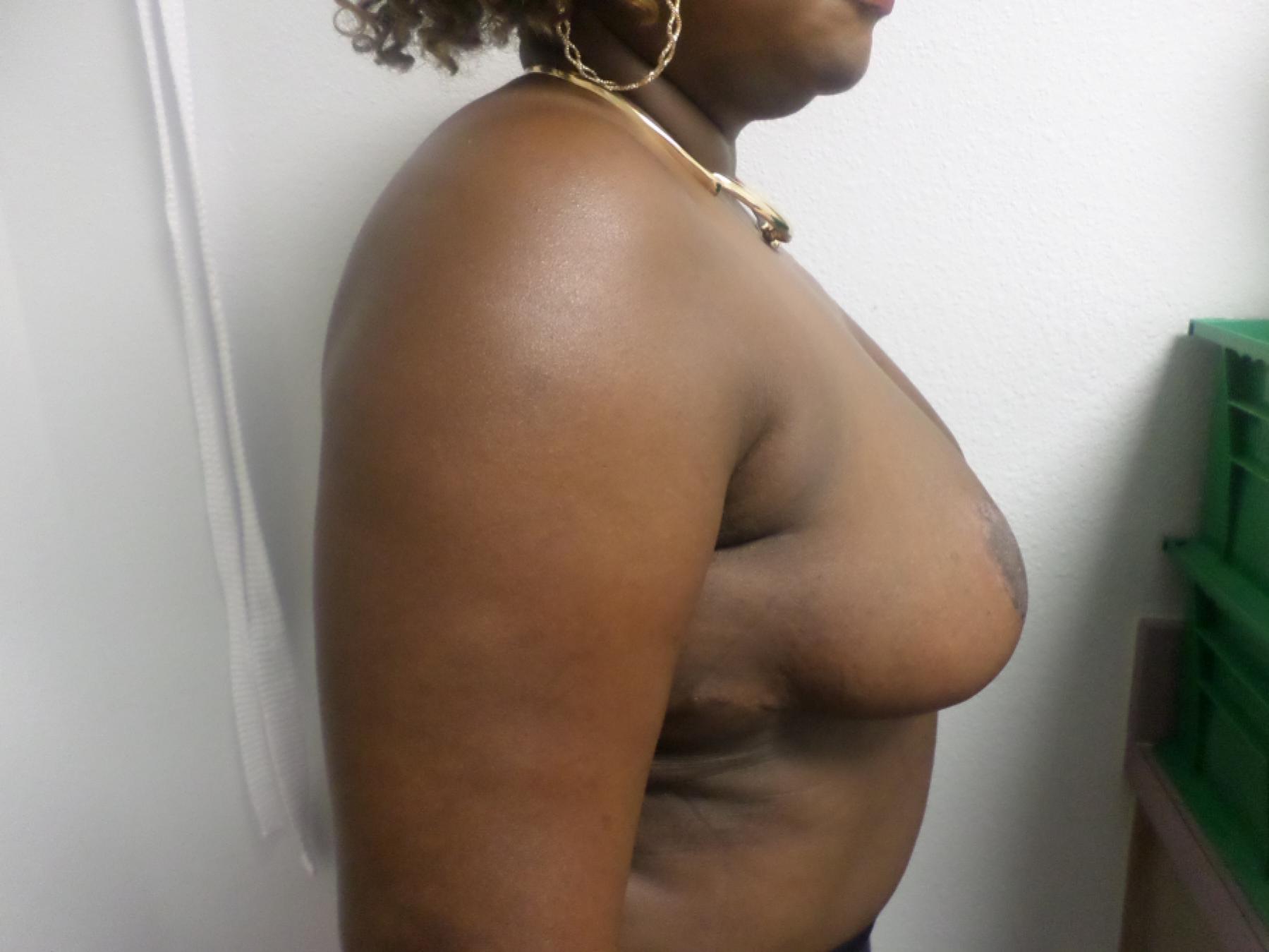 Breast Reduction: Patient 15 - After 4