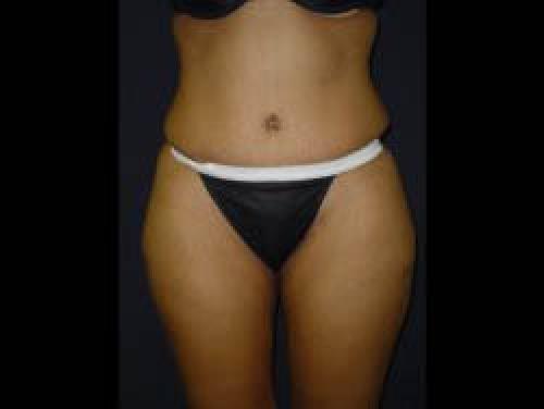 Tummy Tuck - Patient 9 -  After 1