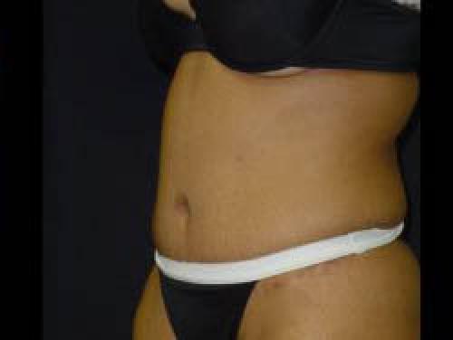 Tummy Tuck - Patient 9 -  After 2