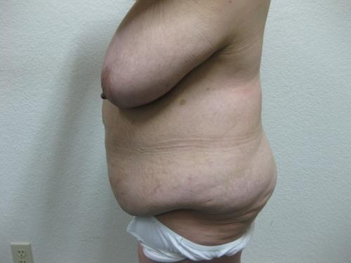Patient 12 - Cosmetic Surgery After Massive Weight Loss - Before 3