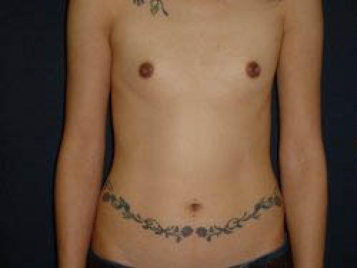 Breast Augmentation - Patient 17 - Before 1