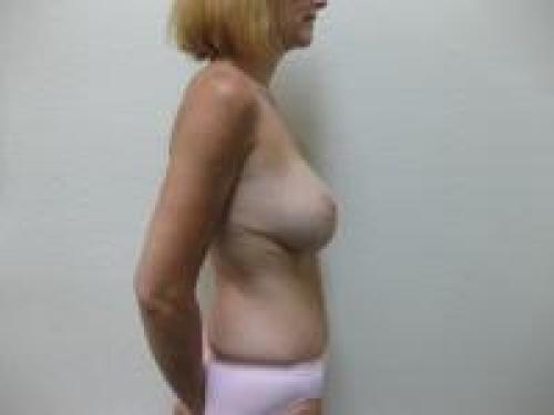 Patient 19 - Cosmetic Surgery After Massive Weight Loss -  After 6
