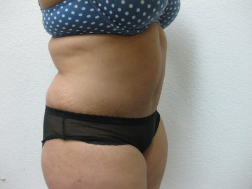 Tummy Tuck - Patient 14 -  After 2