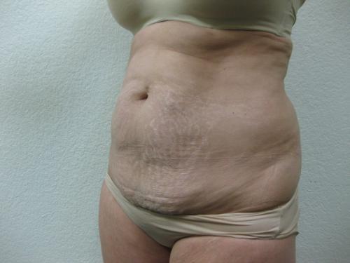 Tummy Tuck - Patient 4 - Before 3