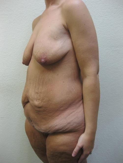 Cosmetic Surgery After Massive Weight Loss - Before 2
