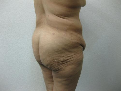 Patient 14 - Cosmetic Surgery After Massive Weight Loss - Before 3
