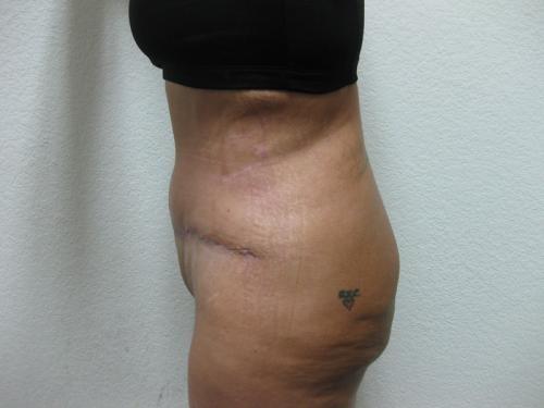 Tummy Tuck - Patient 3 -  After 3