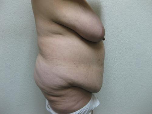 Patient 12 - Cosmetic Surgery After Massive Weight Loss - Before and After 5
