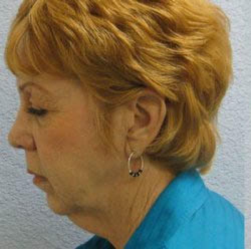 Facelift - Patient 1 - Before