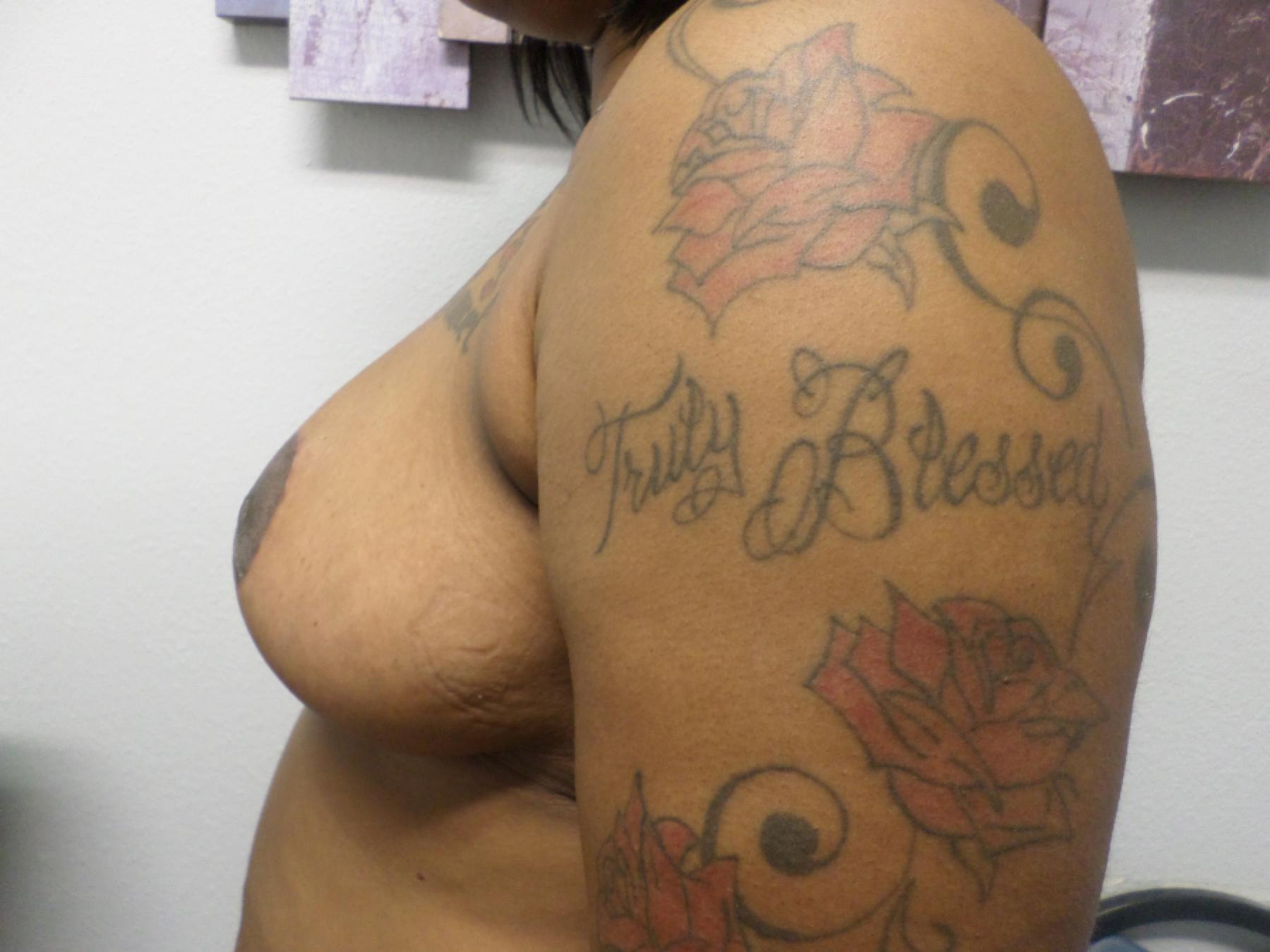 Breast Reduction: Patient 8 - After 3