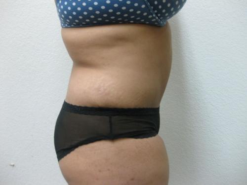Tummy Tuck - Patient 14 -  After 3
