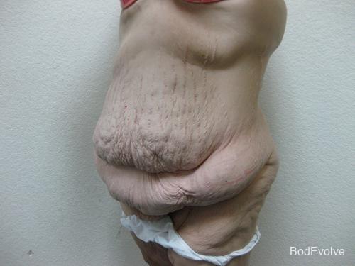 Patient 6 - Cosmetic Surgery After Massive Weight Loss - Before 3