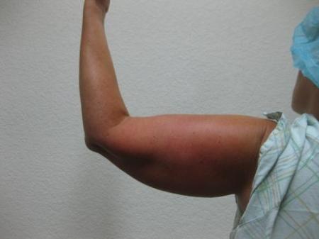 Liposuction - Patient 4 - Before Image 3