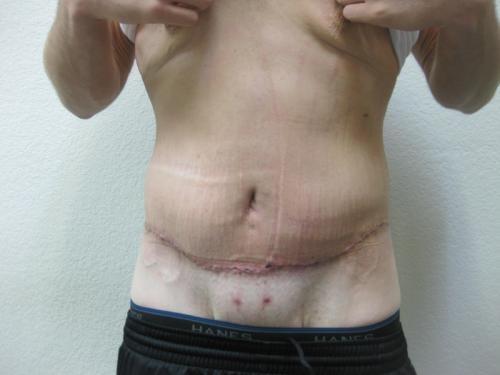 Body Lift - Patient 5 - After 1