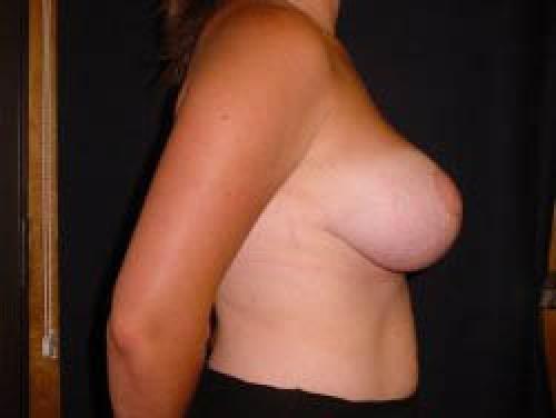 Breast Augmentation with Lift - Patient 5 - After 3