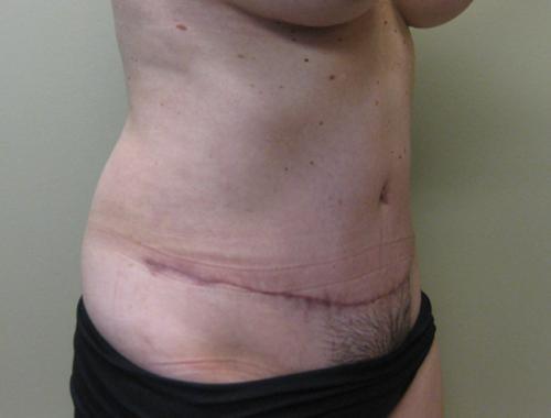 Tummy Tuck - Patient 6 -  After 3