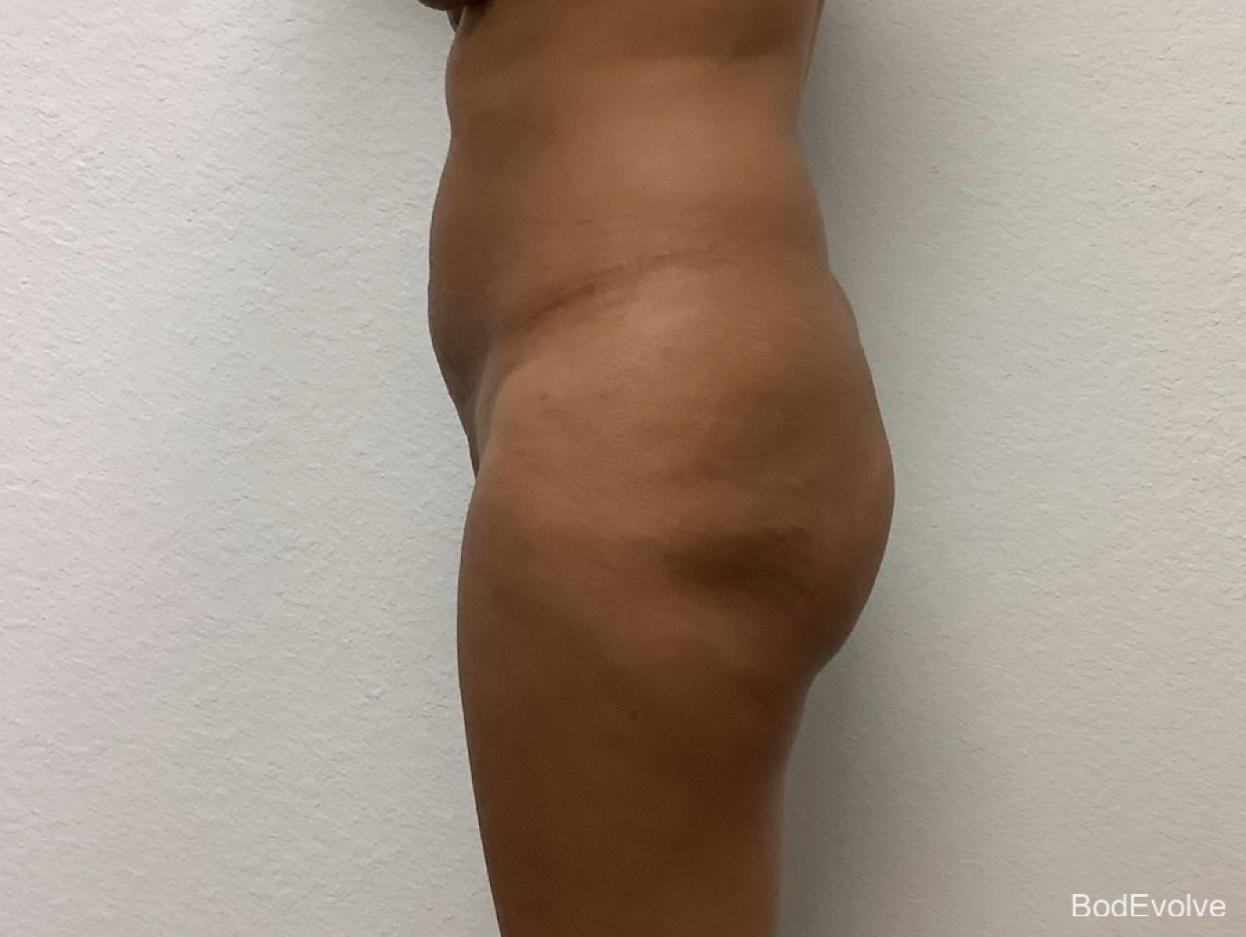 Brazilian Butt Lift: Patient 3 - Before 2