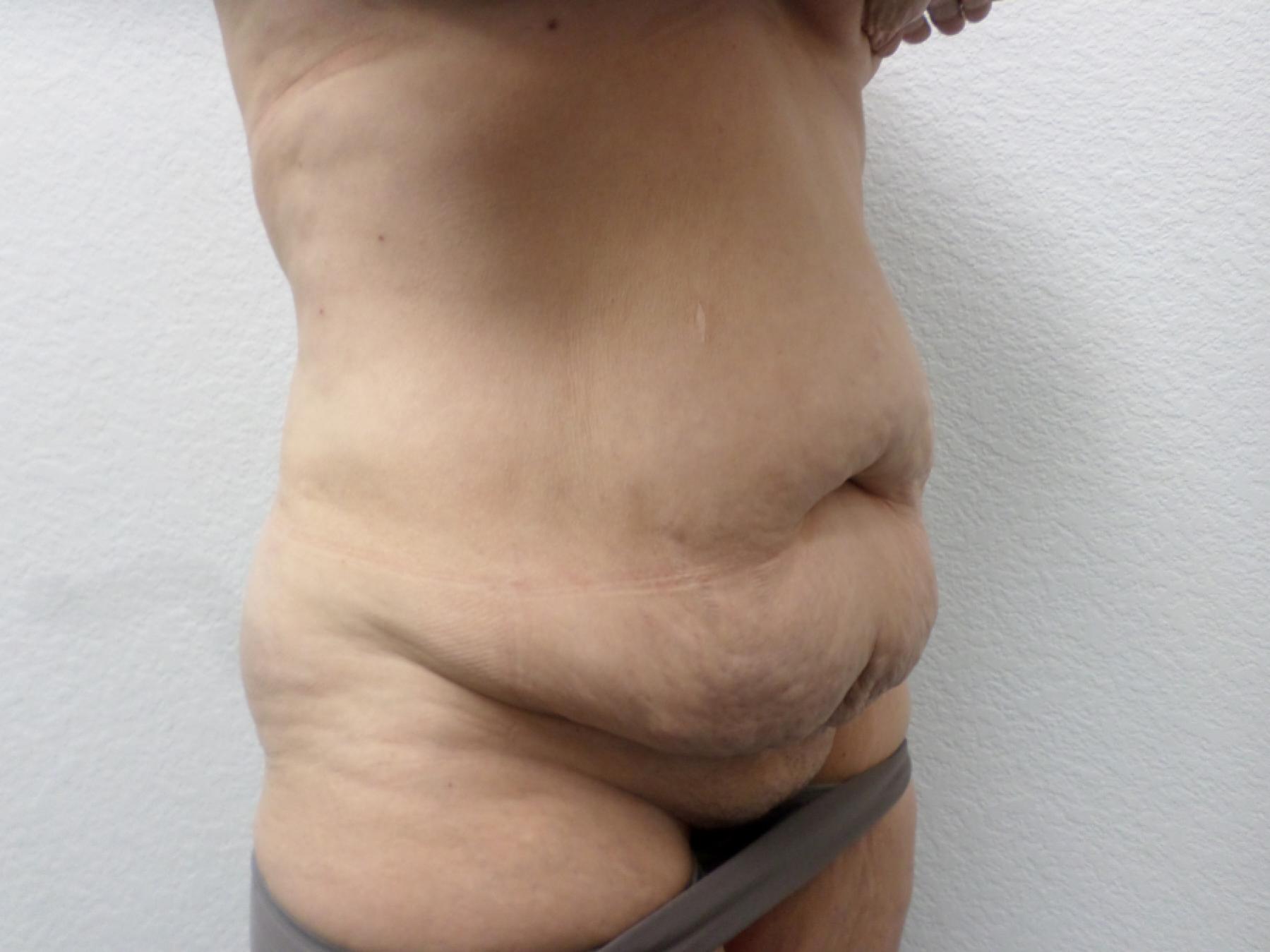 Tummy Tuck: Patient 29 - Before 4