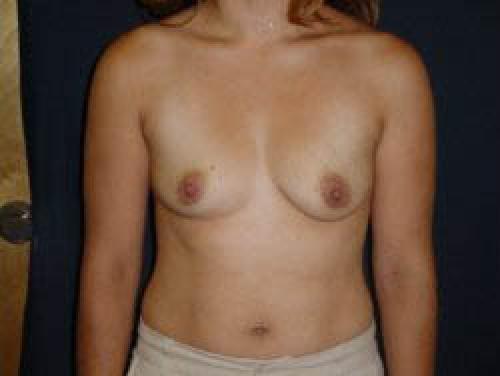 Breast Augmentation - Patient 13 - Before 1