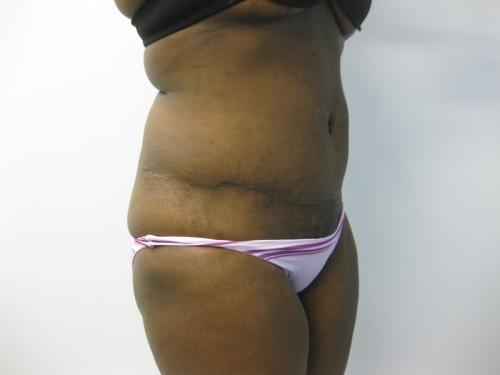 Tummy Tuck - Patient 5 -  After 4