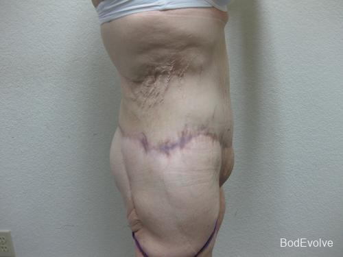 Patient 6 - Cosmetic Surgery After Massive Weight Loss -  After 8