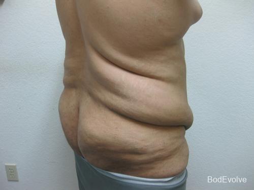 Patient 3 - Cosmetic Surgery After Massive Weight Loss - Before 6