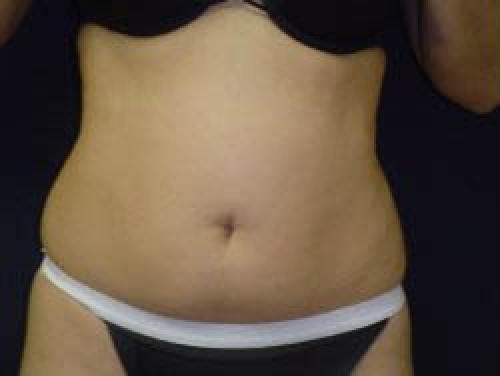 Liposuction - Patient 9 - Before 1