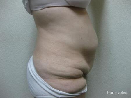 Patient 4 - Cosmetic Surgery After Massive Weight Loss - Before Image 5