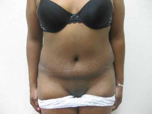 Tummy Tuck - Patient 10 -  After 1
