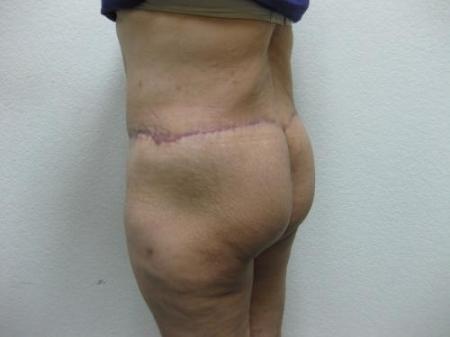 Body Lift - Patient 7 - After Image 5