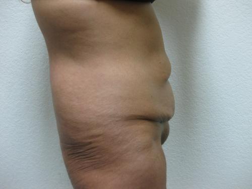 Tummy Tuck - Patient 2 - Before and After 6