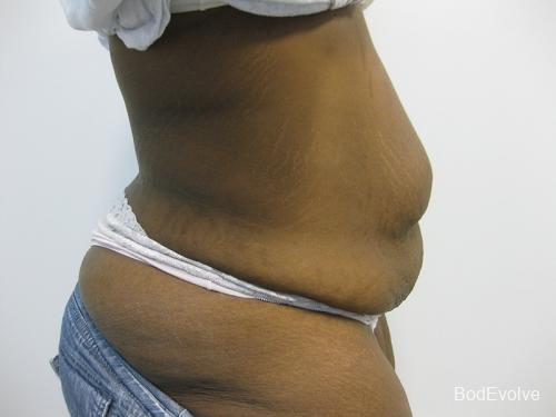 Patient 2 - Cosmetic Surgery After Massive Weight Loss - Before 4
