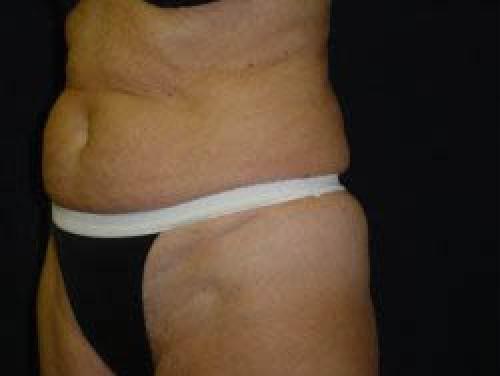 Tummy Tuck - Patient 8 - Before 2