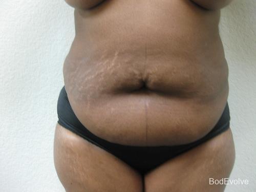 Tummy Tuck - Patient 1 - Before