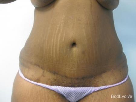 Patient 2 - Cosmetic Surgery After Massive Weight Loss - After 