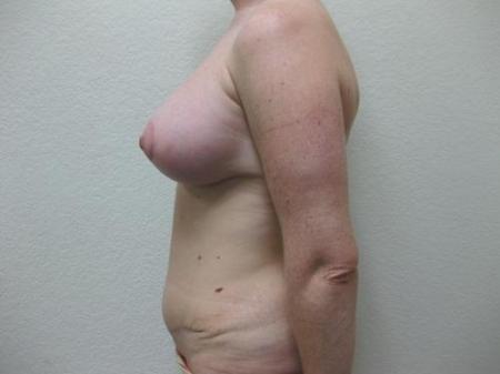 Mommy Makeover - Patient 3 - After Image 3