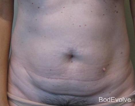Tummy Tuck - Patient 6 - Before 1