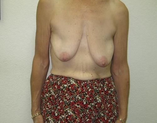 Breast Augmentation with Lift - Patient 11 - Before 1