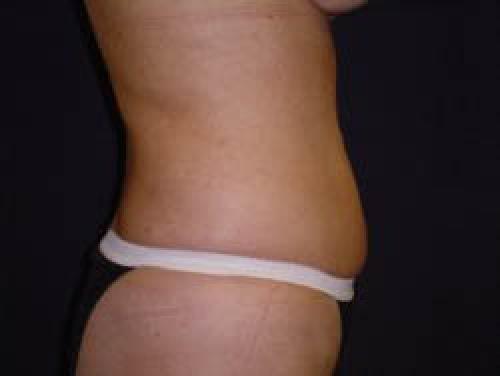 Liposuction - Patient 8 -  After 5