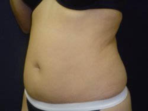 Liposuction - Patient 9 - Before 2