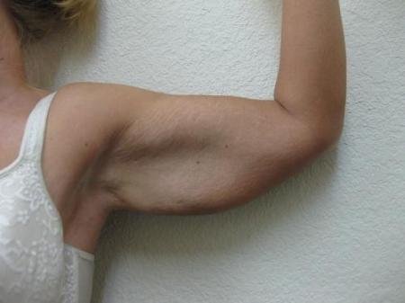 Arm Lift Surgery - Patient 1 - Before Image 1
