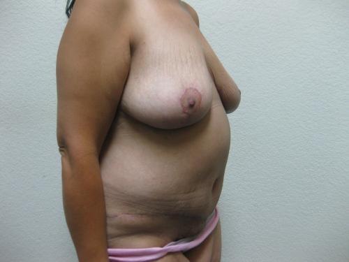 Patient 12 - Cosmetic Surgery After Massive Weight Loss -  After 4