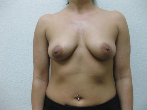 Breast Augmentation - Patient 5 - Before