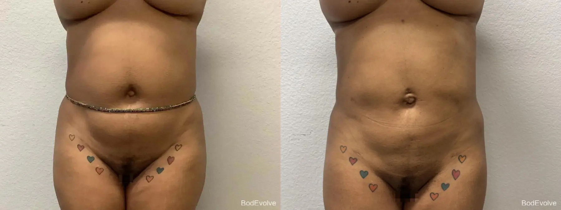 Liposuction: Patient 8 - Before and After  