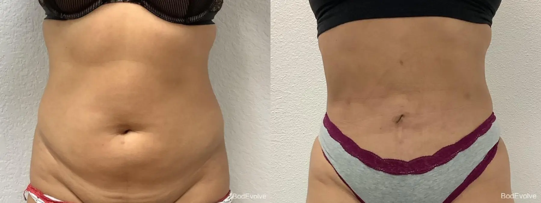 Liposuction: Patient 4 - Before and After  