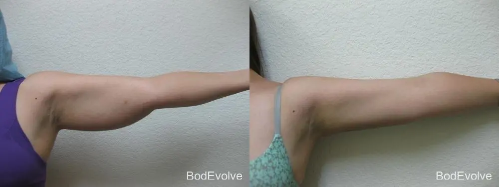 Liposuction - Patient 1 - Before and After 4