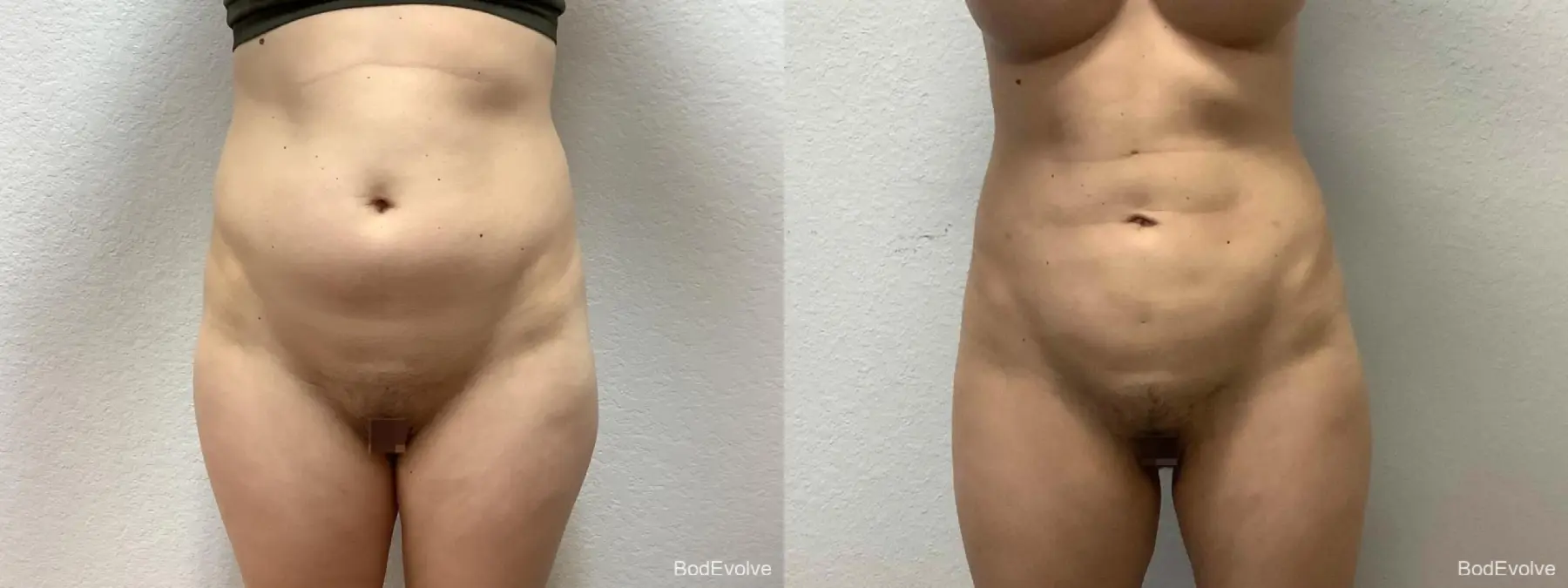 Liposuction: Patient 1 - Before and After  